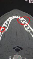 Джошуа сломал Полу челюсть