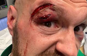Photo of the Day: Fury gets 47 stitches