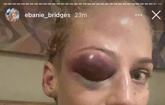 Бриджес после боя с Кортни: «Глаз сейчас больше груди»