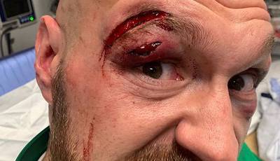 Photo of the Day: Fury gets 47 stitches