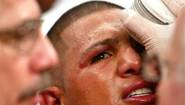 Угол Фернандо Варгаса пытается справится с гематомой возле левого глаза