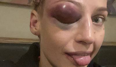 Bridges after Courtenay fight: My eye is bigger than my tits now