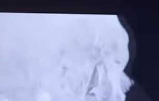 Jake Paul got two titanium plates in his jaw