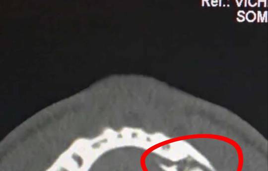 Джошуа зламав Полу щелепу