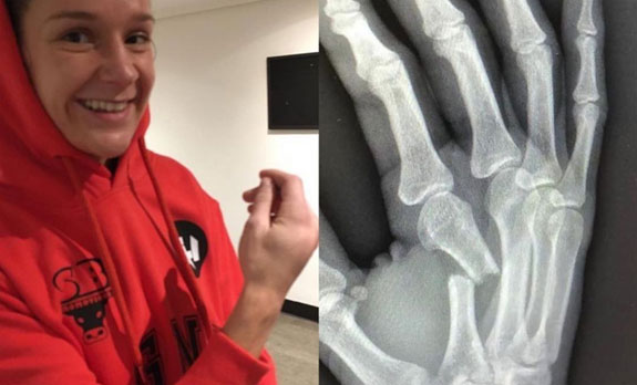 Terry Harper and X-ray of her right arm after the fight against Katharina Thanderz